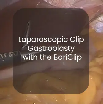 Gastric Clip Surgery - Permanently and safe weight loss