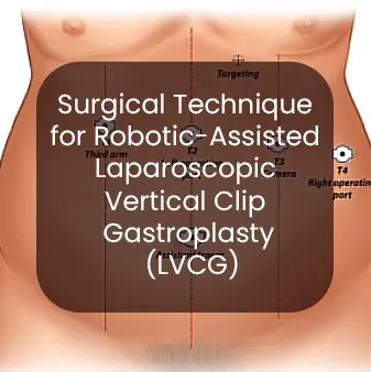 Gastric Clip Surgery - Permanently and safe weight loss