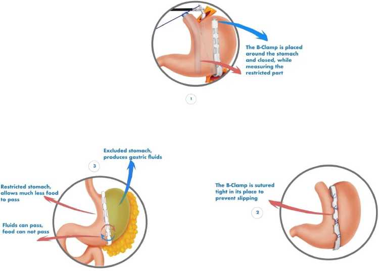 Gastric Clip Surgery - Fast Weight Loss