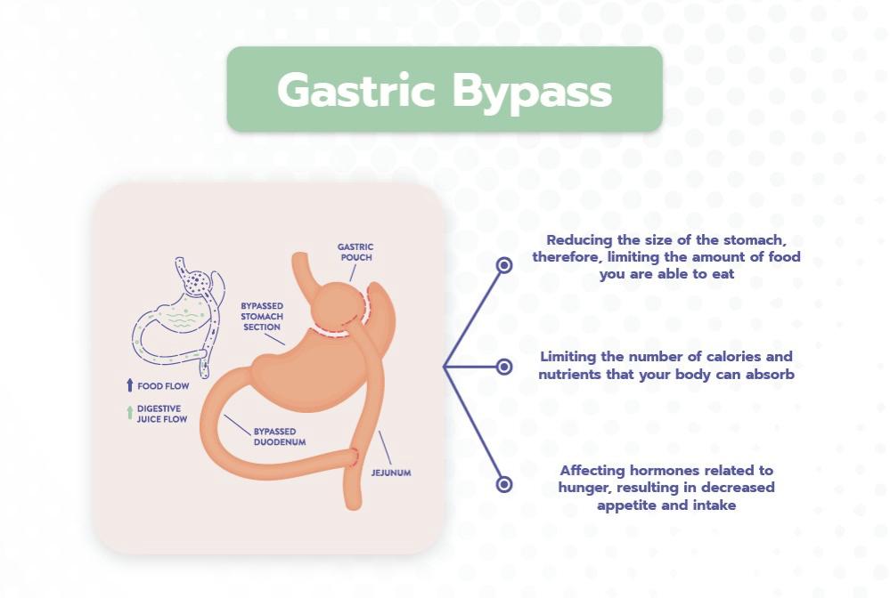 Gastric Clip Surgery - Permanently and safe weight loss