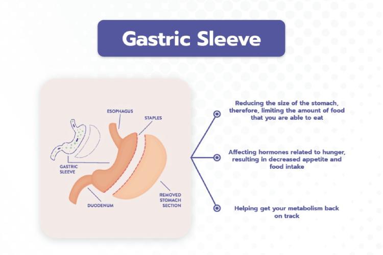 Gastric Clip Surgery - Permanently and safe weight loss