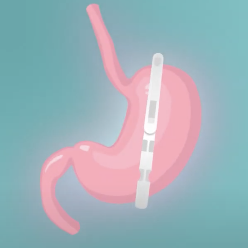 Gastric Clip Surgery - Permanently and safe weight loss