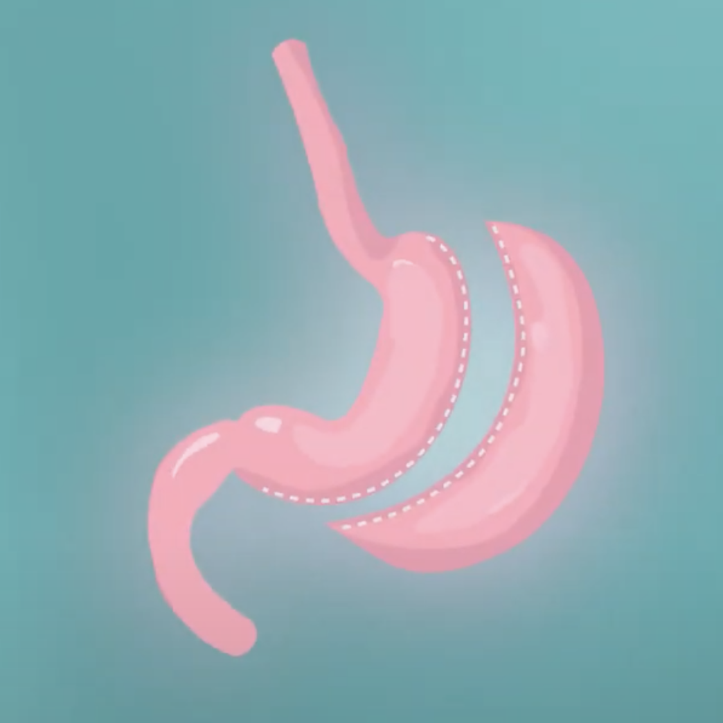 Gastric Clip Surgery - Permanently and safe weight loss